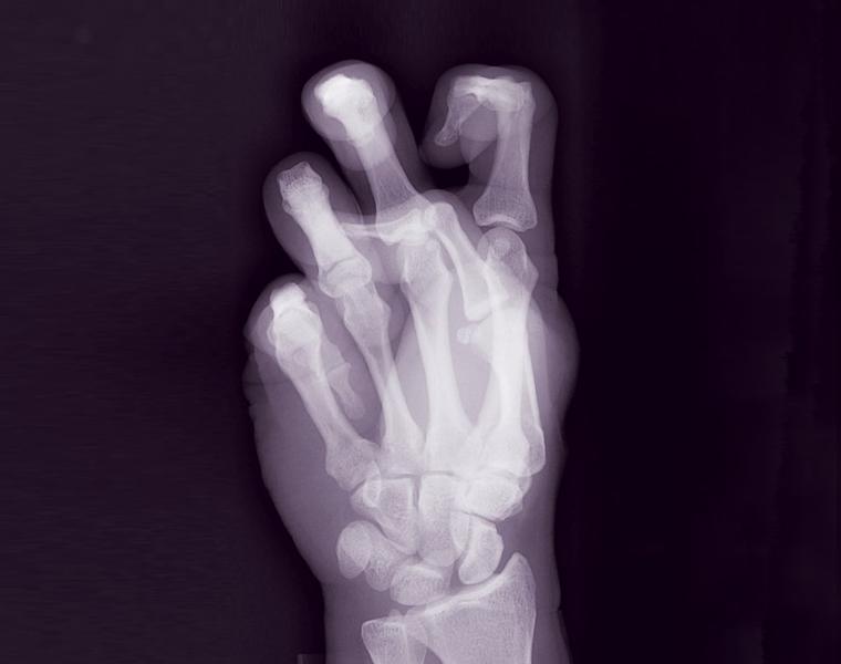 X-ray of 